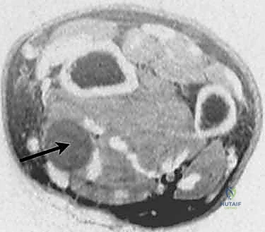 الفحص السريري لأورام اليد