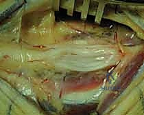 صورة توضيحية لـ أورام الأعصاب الطرفية في اليد والرسغ: دليل شامل لاستئصالها وإعادة بنائها مع الأستاذ الدكتور محمد هطيف