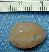 صورة توضيحية لـ أورام الأعصاب الطرفية في اليد والرسغ: دليل شامل لاستئصالها وإعادة بنائها مع الأستاذ الدكتور محمد هطيف