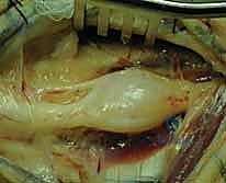 التخطيط العصبي والعضلي