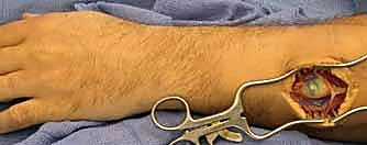 خطوات الاستئصال الجراحي الميكروسكوبي