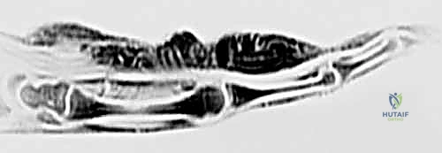 التشريح الدقيق لأعصاب اليد والرسغ