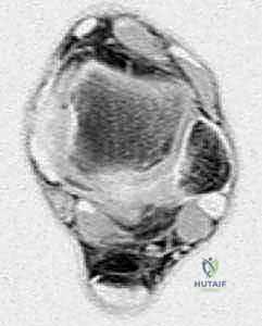 Endoscopic Retrocalcaneal Decompression for Haglund Syndrome: A Masterclass