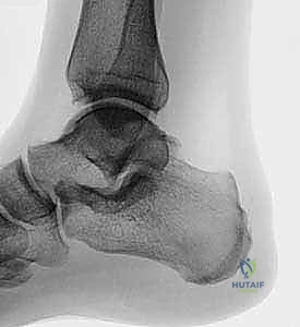 صورة توضيحية لـ متلازمة هاغلوند وتخفيف الضغط بالمنظار: حل نهائي لآلام كعب القدم في صنعاء