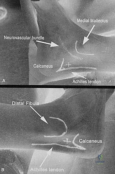 صورة توضيحية لـ متلازمة هاغلوند وتخفيف الضغط بالمنظار: حل نهائي لآلام كعب القدم في صنعاء