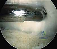 صورة توضيحية لـ متلازمة هاغلوند وتخفيف الضغط بالمنظار: حل نهائي لآلام كعب القدم في صنعاء