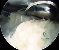 متلازمة هاغلوند وتخفيف الضغط بالمنظار: حل نهائي لآلام كعب القدم في صنعاء