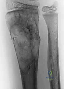 ورم الخلايا العملاقة في المعصم