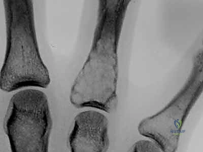 الورم الغضروفي الداخلي في عظام اليد