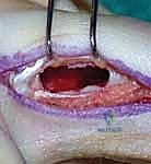 التخطيط الجراحي الدقيق لأورام العظام