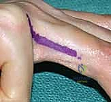 أورام العظام في اليد والمعصم والطرف العلوي: دليل شامل للعلاج مع الأستاذ الدكتور محمد هطيف