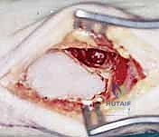 النتائج الجراحية الممتازة والتئام العظم