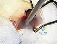 الترقيع العظمي بعد استئصال الورم