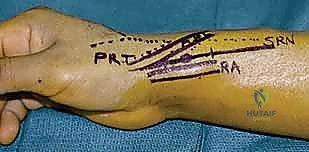 خطوات الكشط الجراحي لورم في اليد