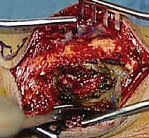 الأشعة السينية لتشخيص أورام اليد