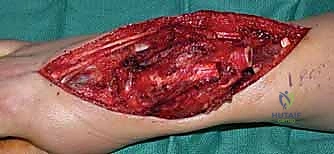 متابعة التئام العظم بعد العملية