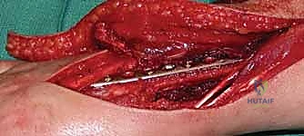 استعادة وظيفة اليد بالكامل بعد العلاج