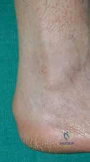 اعتلال وتر أخيل الارتكازي - دكتور محمد هطيف