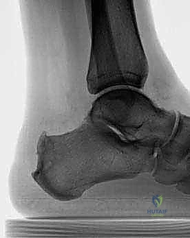 صورة طبية: التخلص من ألم وتر أخيل الارتكازي: دليل شامل للعلاج الجراحي وغير الجراحي