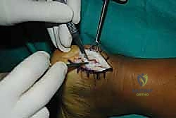 الأعراض السريرية وتورم الكعب