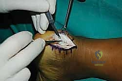 صور الأشعة السينية لتشوه هاغلوند