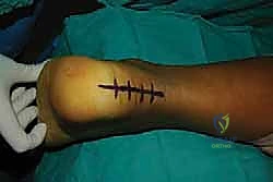 توضح النتوء العظمي وتشوه هاغلوند