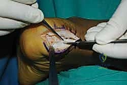 فحص سريري لوتر أخيل