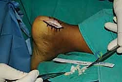 تعديل الأحذية ورفع الكعب