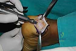 استئصال النتوء العظمي هاغلوند