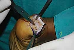 تنضير الأنسجة التالفة