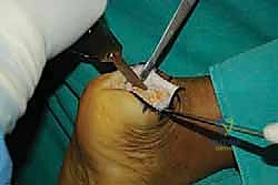 التشريح الدقيق لوتر أخيل