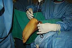 صورة توضيحية لـ التخلص من ألم وتر أخيل الارتكازي: دليل شامل للعلاج الجراحي وغير الجراحي