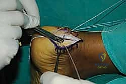 صورة طبية: التخلص من ألم وتر أخيل الارتكازي: دليل شامل للعلاج الجراحي وغير الجراحي