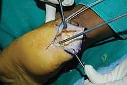 صورة توضيحية لـ التخلص من ألم وتر أخيل الارتكازي: دليل شامل للعلاج الجراحي وغير الجراحي