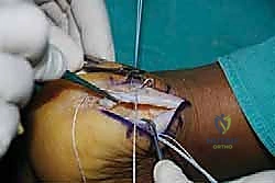 صورة توضيحية لـ التخلص من ألم وتر أخيل الارتكازي: دليل شامل للعلاج الجراحي وغير الجراحي