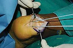 صورة طبية: التخلص من ألم وتر أخيل الارتكازي: دليل شامل للعلاج الجراحي وغير الجراحي