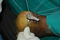 صورة طبية: التخلص من ألم وتر أخيل الارتكازي: دليل شامل للعلاج الجراحي وغير الجراحي