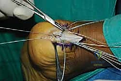 صورة طبية: التخلص من ألم وتر أخيل الارتكازي: دليل شامل للعلاج الجراحي وغير الجراحي