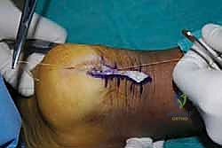 صورة طبية: التخلص من ألم وتر أخيل الارتكازي: دليل شامل للعلاج الجراحي وغير الجراحي