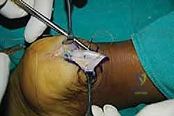 صورة طبية: التخلص من ألم وتر أخيل الارتكازي: دليل شامل للعلاج الجراحي وغير الجراحي