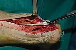 صورة طبية: التخلص من ألم وتر أخيل الارتكازي: دليل شامل للعلاج الجراحي وغير الجراحي