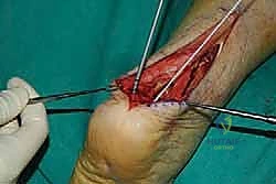 صورة طبية: التخلص من ألم وتر أخيل الارتكازي: دليل شامل للعلاج الجراحي وغير الجراحي