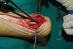 صورة طبية: التخلص من ألم وتر أخيل الارتكازي: دليل شامل للعلاج الجراحي وغير الجراحي