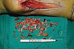 صورة طبية: التخلص من ألم وتر أخيل الارتكازي: دليل شامل للعلاج الجراحي وغير الجراحي