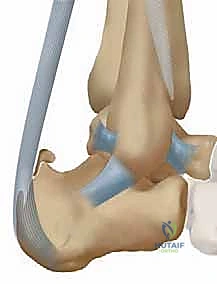 النهج الجانبي لعلاج التهاب وتر أخيل التكلسي: حل شامل لآلام الكعب المزمنة في صنعاء
