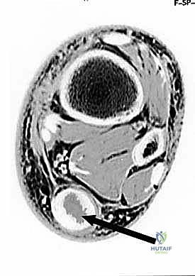 خطوات النهج الجانبي الجراحي لوتر أخيل