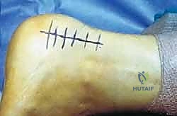 النهج الجانبي لعلاج التهاب وتر أخيل التكلسي: حل شامل لآلام الكعب المزمنة في صنعاء