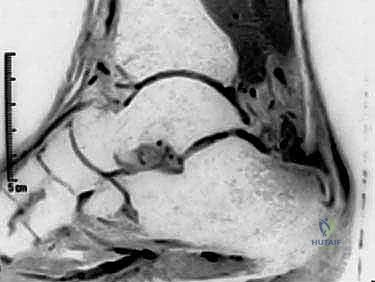 تنظيف الأنسجة التالفة من الوتر