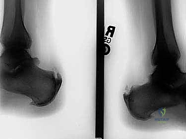 التحضير لجراحة تعزيز وتر أخيل