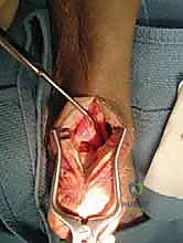 صورة توضيحية لـ علاج اعتلال وتر أخيل الإدخالي المزمن: دليل شامل لتعزيز الوتر باستخدام وتر FHL مع الأستاذ الدكتور محمد هطيف